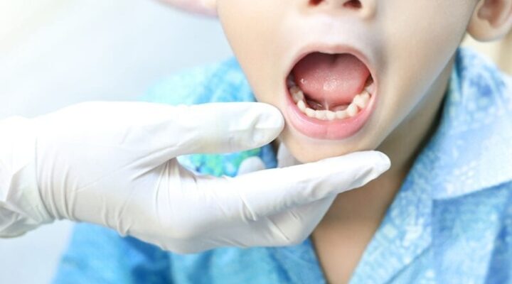 Frenectomy In Infants